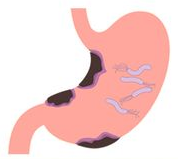 ピロリ菌がすみついた胃のイラスト